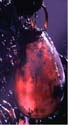 Neonatal blob: